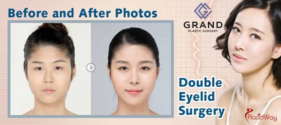 Double Eyelid Surgery in South Korea